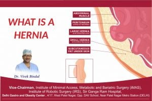 Read more about the article What is Hernia?