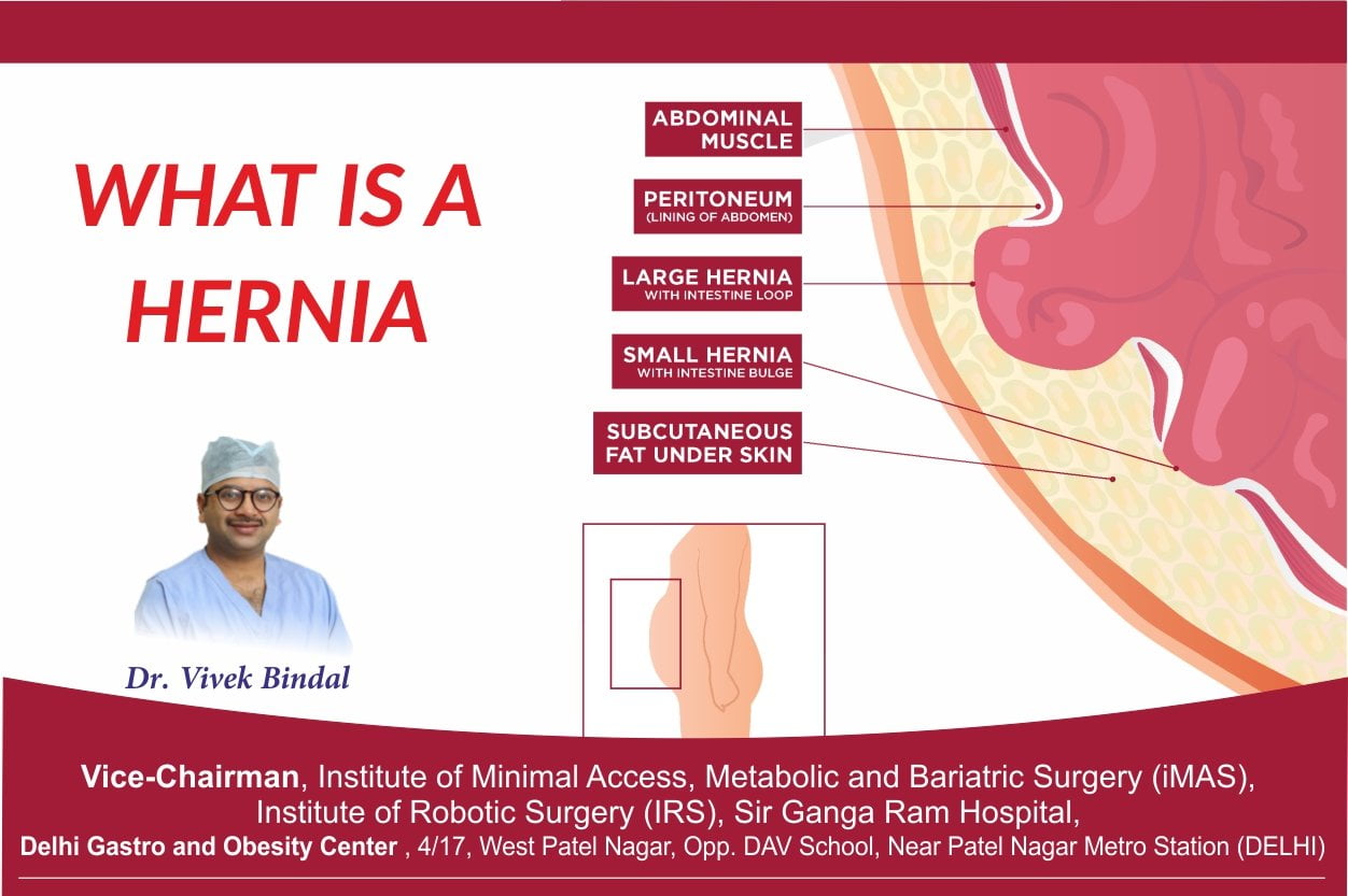 Read more about the article What is Hernia?