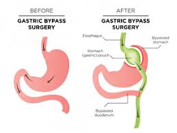 Read more about the article Bariatric Surgery ( or Weight Loss Surgery)