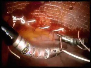 Read more about the article Robotic approach for large lateral incisional hernia