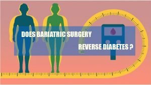 Read more about the article DOES BARIATRIC SURGERY REVERSE DIABETES ?