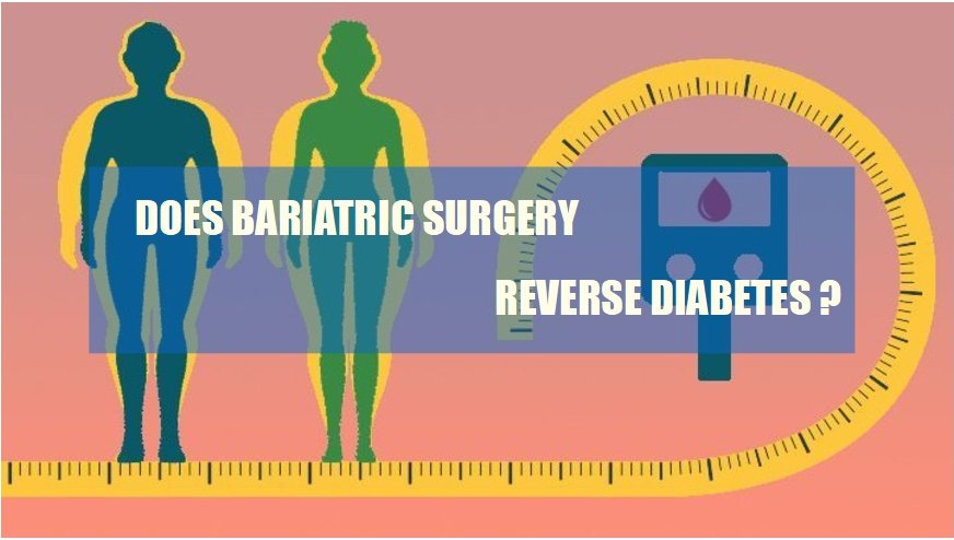 Read more about the article DOES BARIATRIC SURGERY REVERSE DIABETES ?